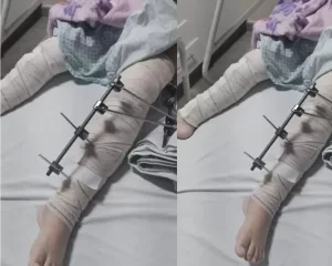 médicos operam perna errada de menina de 6 anos e caso gera revolta » Conexão Política