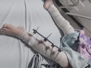 Menina de 6 anos cai da bicicleta e médicos fazem cirurgia em perna errada